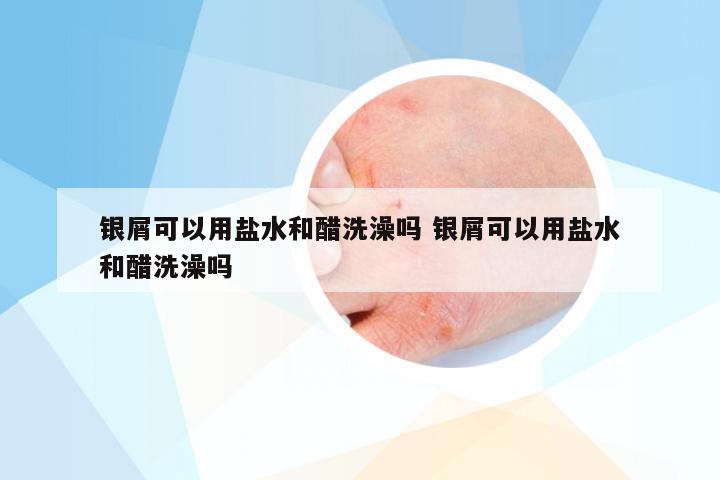 银屑可以用盐水和醋洗澡吗 银屑可以用盐水和醋洗澡吗