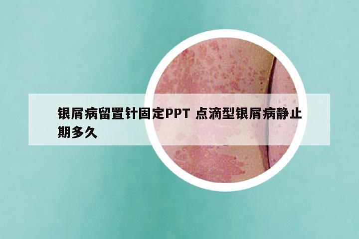 银屑病留置针固定PPT 点滴型银屑病静止期多久