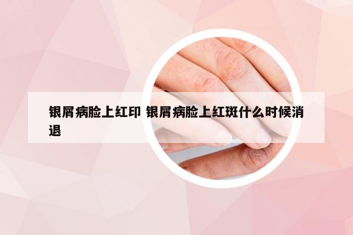 银屑病脸上红印 银屑病脸上红斑什么时候消退