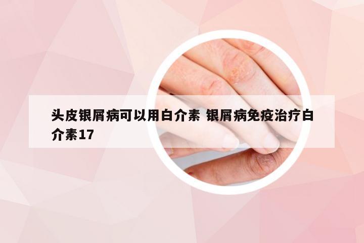 头皮银屑病可以用白介素 银屑病免疫治疗白介素17