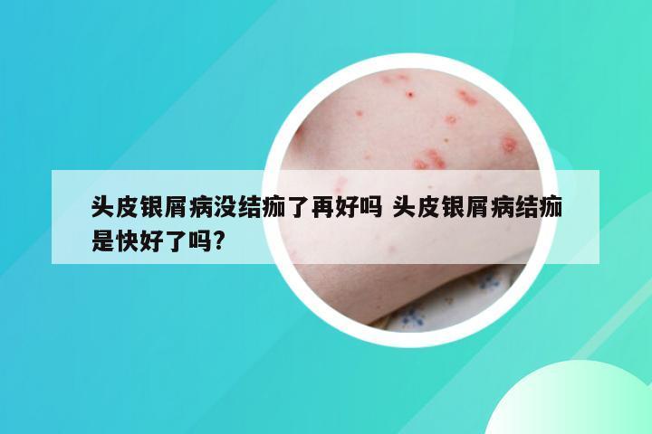 头皮银屑病没结痂了再好吗 头皮银屑病结痂是快好了吗?