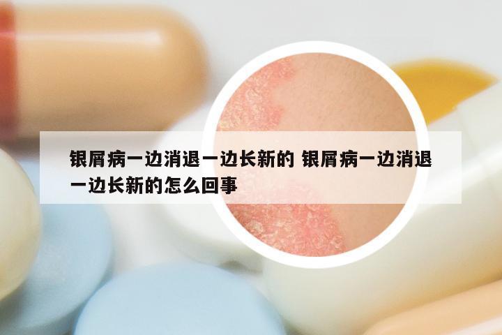 银屑病一边消退一边长新的 银屑病一边消退一边长新的怎么回事