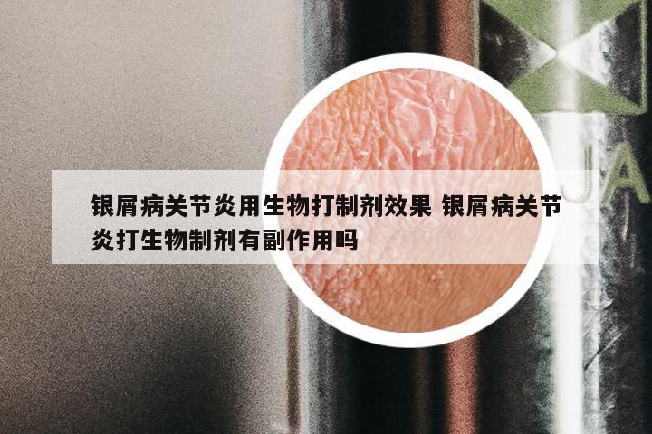 银屑病关节炎用生物打制剂效果 银屑病关节炎打生物制剂有副作用吗