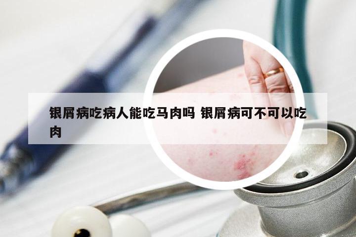 银屑病吃病人能吃马肉吗 银屑病可不可以吃肉