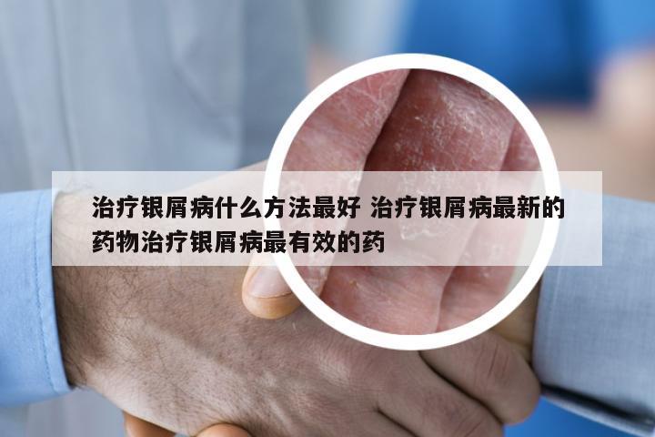 治疗银屑病什么方法最好 治疗银屑病最新的药物治疗银屑病最有效的药