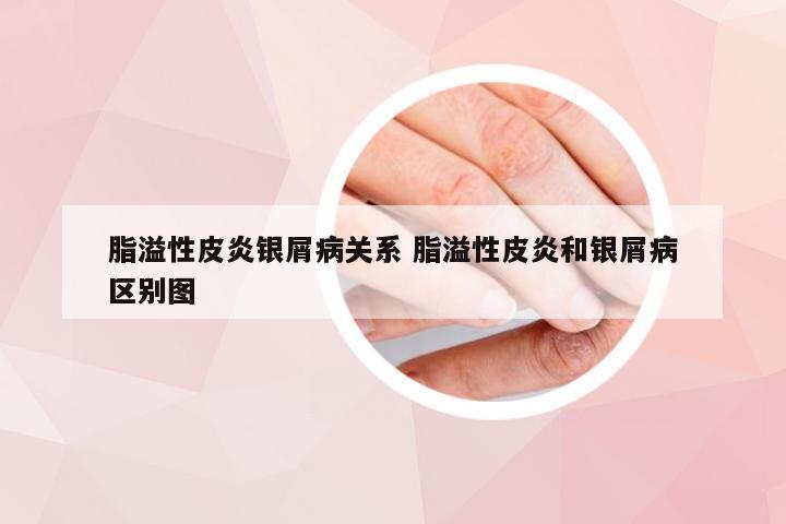 脂溢性皮炎银屑病关系 脂溢性皮炎和银屑病区别图