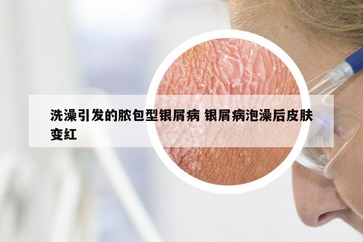 洗澡引发的脓包型银屑病 银屑病泡澡后皮肤变红