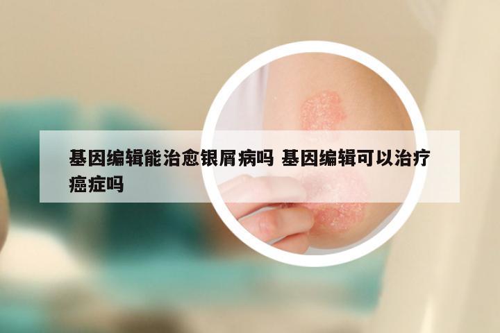 基因编辑能治愈银屑病吗 基因编辑可以治疗癌症吗