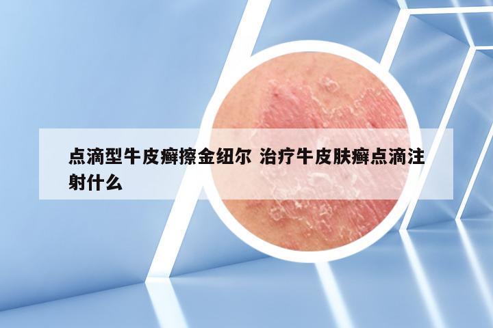 点滴型牛皮癣擦金纽尔 治疗牛皮肤癣点滴注射什么