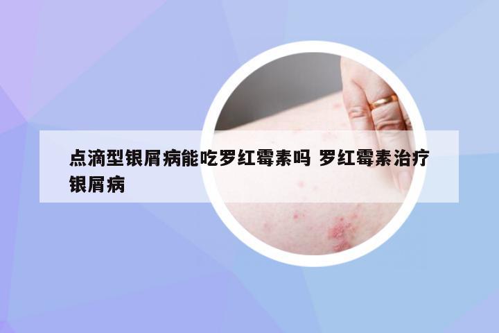 点滴型银屑病能吃罗红霉素吗 罗红霉素治疗银屑病