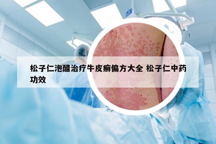 松子仁泡醋治疗牛皮癣偏方大全 松子仁中药功效