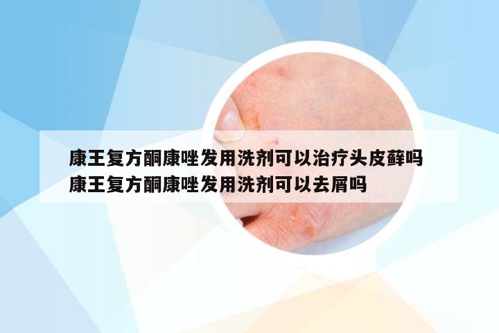 康王复方酮康唑发用洗剂可以治疗头皮藓吗 康王复方酮康唑发用洗剂可以去屑吗