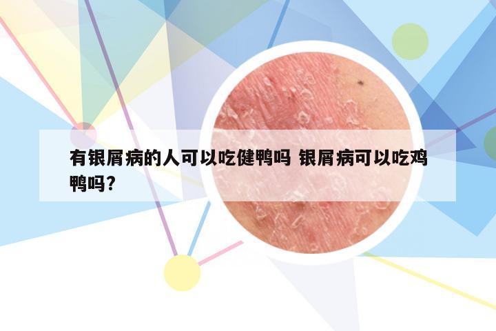 有银屑病的人可以吃健鸭吗 银屑病可以吃鸡鸭吗?