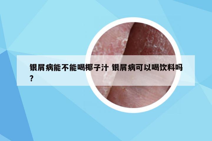 银屑病能不能喝椰子汁 银屑病可以喝饮料吗?