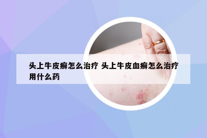 头上牛皮癣怎么治疗 头上牛皮血癣怎么治疗用什么药