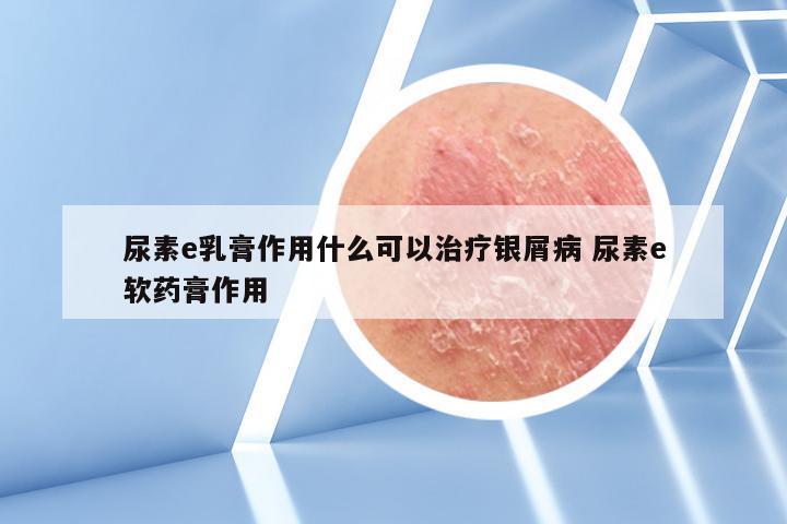 尿素e乳膏作用什么可以治疗银屑病 尿素e软药膏作用