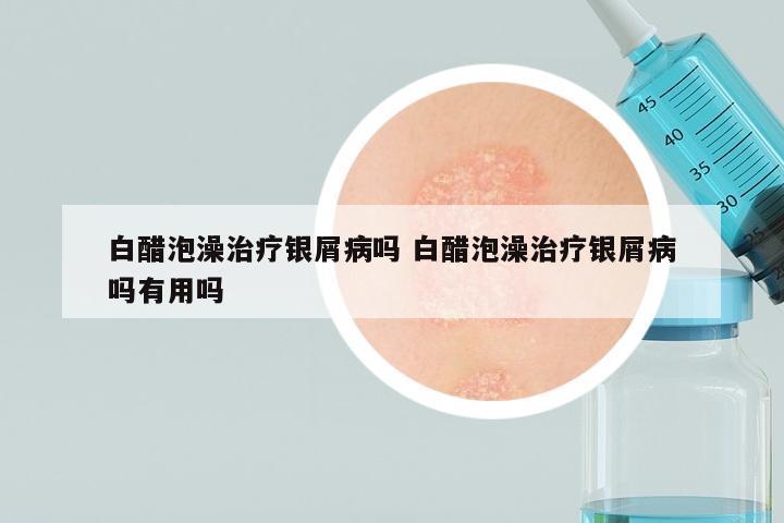 白醋泡澡治疗银屑病吗 白醋泡澡治疗银屑病吗有用吗