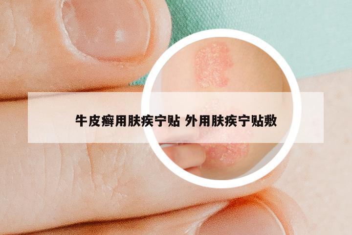 牛皮癣用肤疾宁贴 外用肤疾宁贴敷