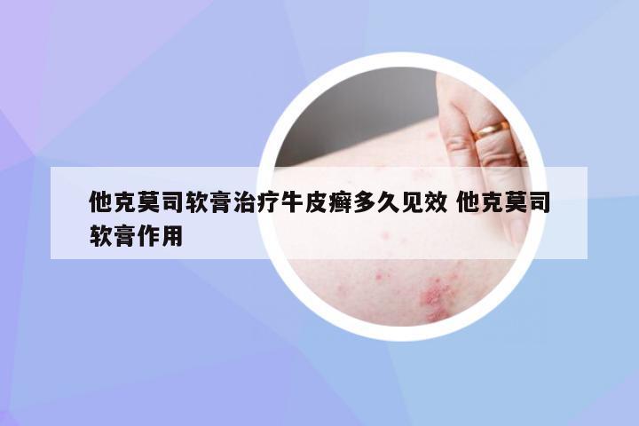 他克莫司软膏治疗牛皮癣多久见效 他克莫司软膏作用