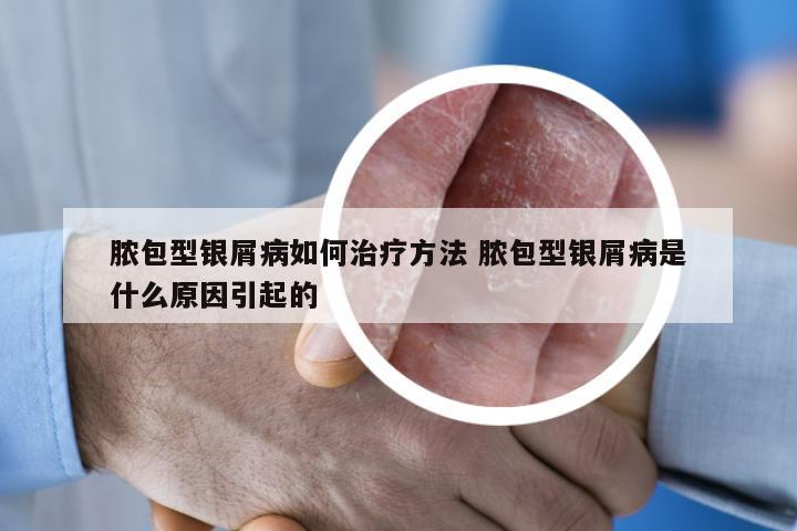 脓包型银屑病如何治疗方法 脓包型银屑病是什么原因引起的