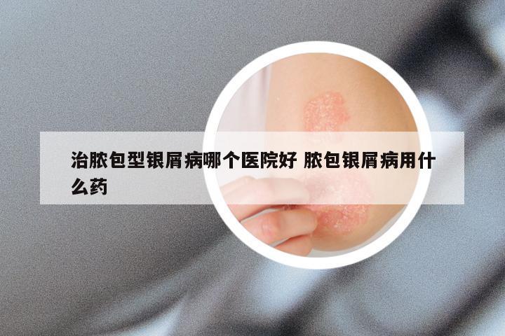 治脓包型银屑病哪个医院好 脓包银屑病用什么药