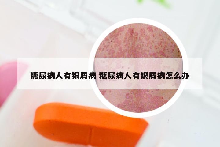 糖尿病人有银屑病 糖尿病人有银屑病怎么办