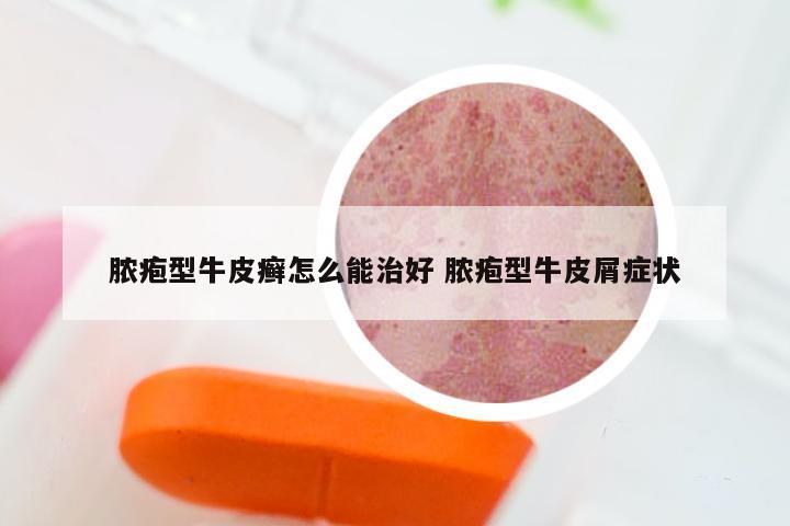 脓疱型牛皮癣怎么能治好 脓疱型牛皮屑症状