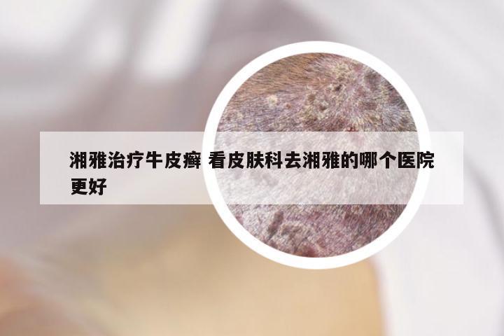 湘雅治疗牛皮癣 看皮肤科去湘雅的哪个医院更好