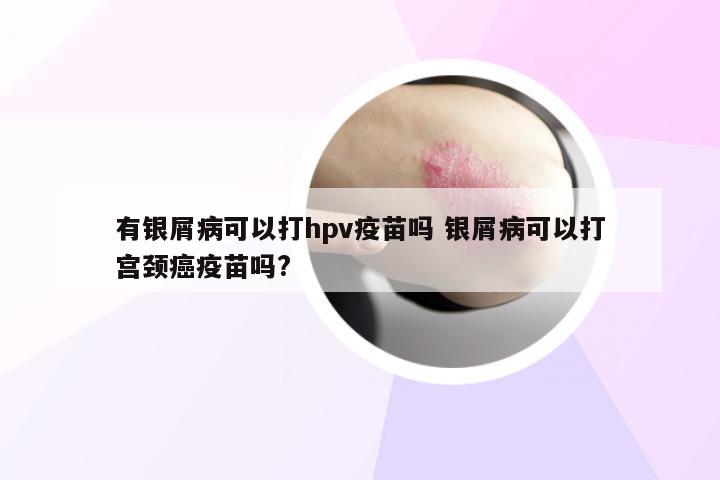 有银屑病可以打hpv疫苗吗 银屑病可以打宫颈癌疫苗吗?