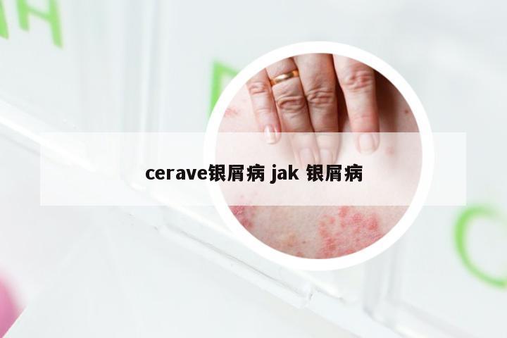 cerave银屑病 jak 银屑病