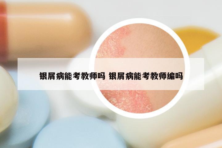 银屑病能考教师吗 银屑病能考教师编吗