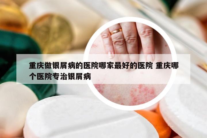 重庆做银屑病的医院哪家最好的医院 重庆哪个医院专治银屑病